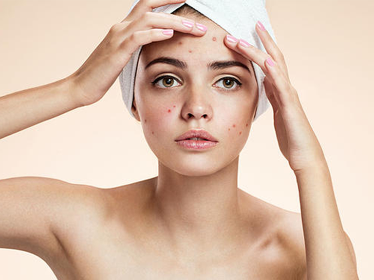 Dưỡng ẩm là bước chăm sóc da quan trọng hàng đầu đối với tất cả làn da, kể cả da mụn